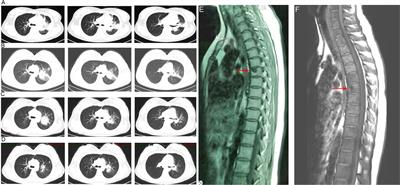 Case report: Diagnosis of Talaromyces marneffei infection in an HIV-negative patient with septic shock and high-titer anti-interferon gamma autoantibodies by metagenomic next-generation sequencing